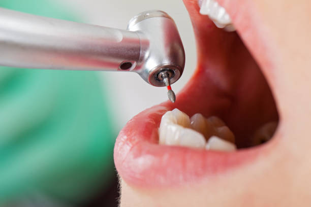Best Emergency Dental Care for Broken or Chipped Teeth in Perham, MN